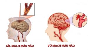 Tai biến mạch máu não là gì?