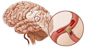 Tai biến mạch máu não: Nguyên nhân và cách điều trị